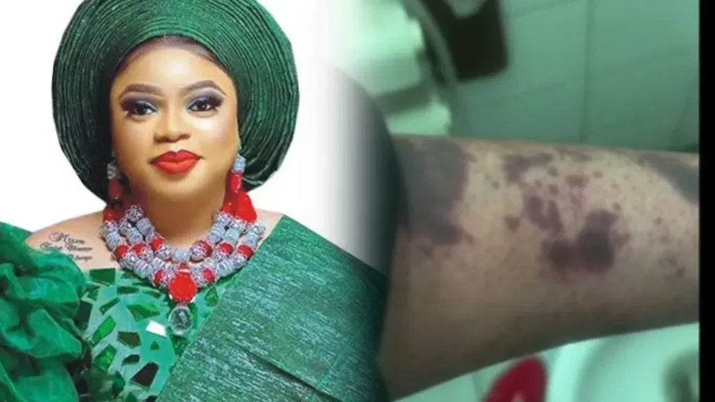 bobrisky-injury